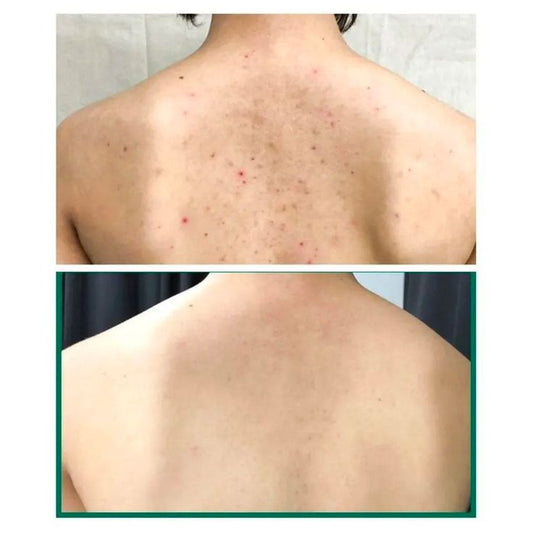 SOME BY MI | AHA-BHA-PHA 30 days Miracle Acne Body Cleanser - 400g (detergente corpo)