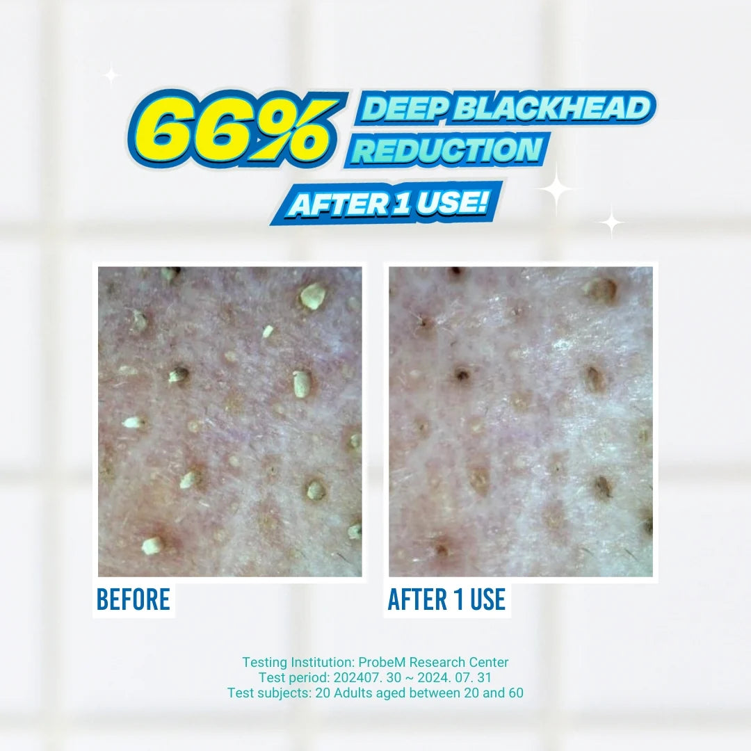 Jumiso | Blackhead Melting Softener 150ml + 40 pads + 10 estrattori